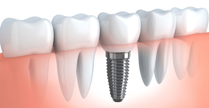 tooth implants