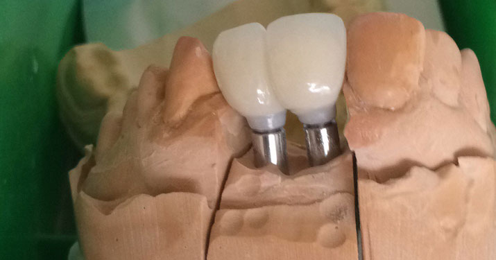 dentures